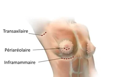Augmentation mammaire lincision Augmentation mammaire l’incision