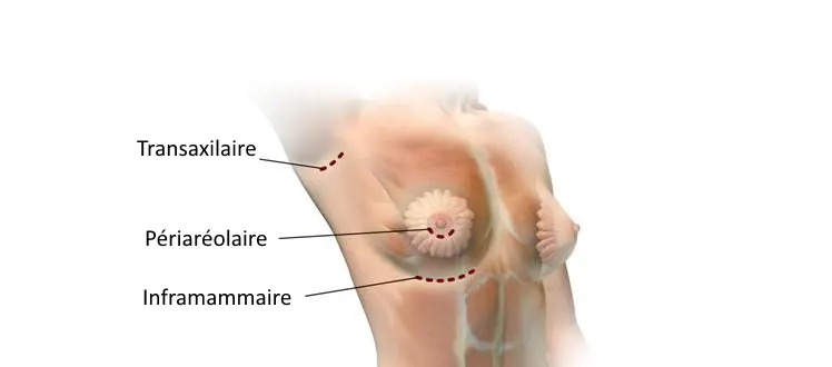 Augmentation mammaire l’incision