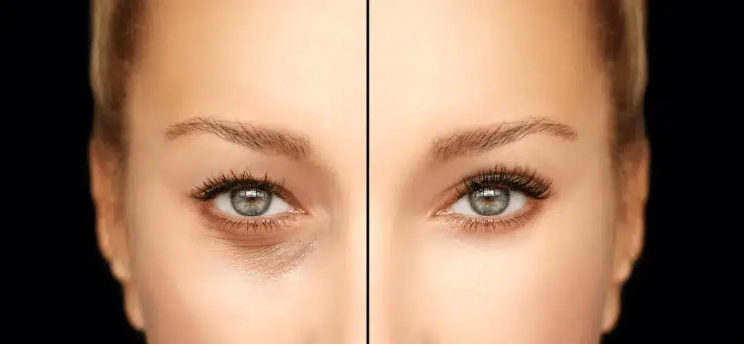 Avant après blépharoplastie