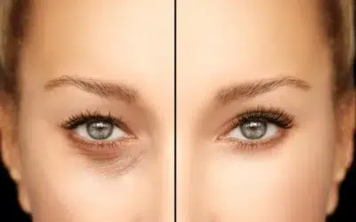 Avant après blépharoplastie