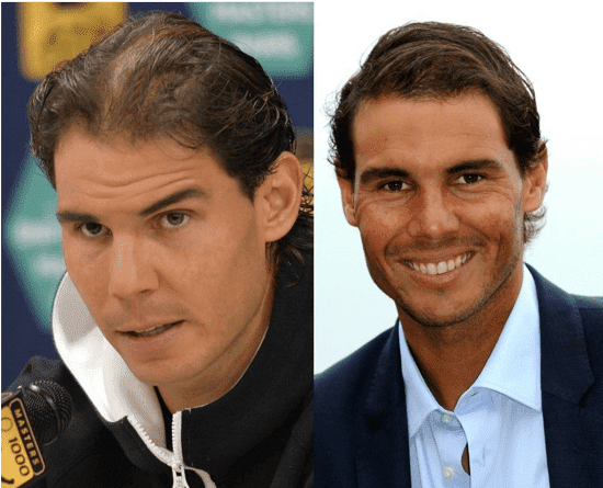 rafael nadal greffe de cheveux tennis