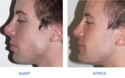 rhinoplastie et types de peau Rhinoplastie homme gros nez