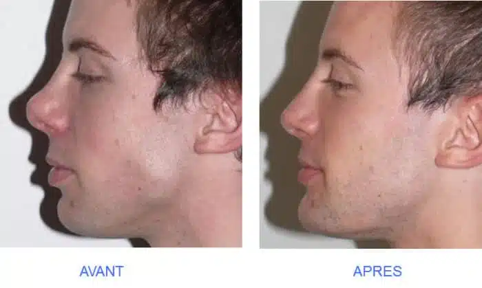 Rhinoplastie homme gros nez