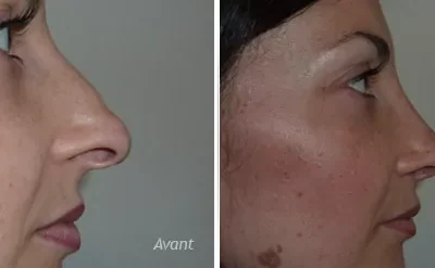 rhinoplastie secondaire Rhinoplastie de révision