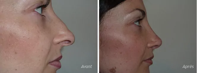 rhinoplastie secondaire ou rhinoplastie de révision