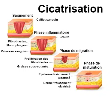 cicatrisation