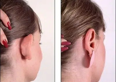 Otoplastie à quel âge réaliser l'intervention ?