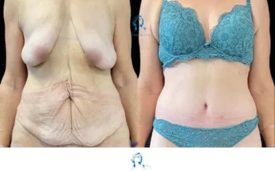 Chirurgie apres perte de poids Chirurgie esthétique après une grande perte de poids