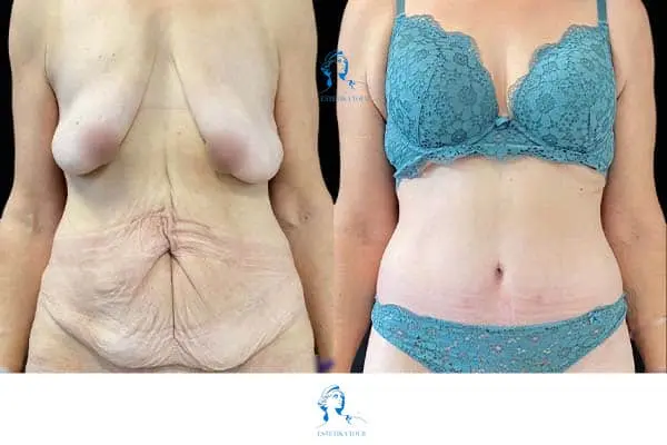 Chirurgie esthétique après une grande perte de poids, Appréhensions patients à propos de l'abdominoplastie, Abdominoplastie ou liposuccion