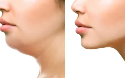 double menton Double menton ? Découvrez la liposuccion du menton