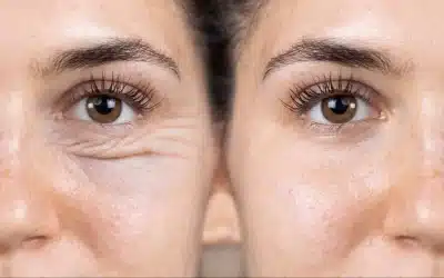 Blépharoplastie paupière; une opération fonctionnelle et esthétique