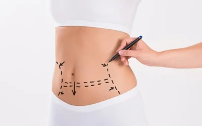 abdominoplastie Guérison après l’abdominoplastie conseils des médecins