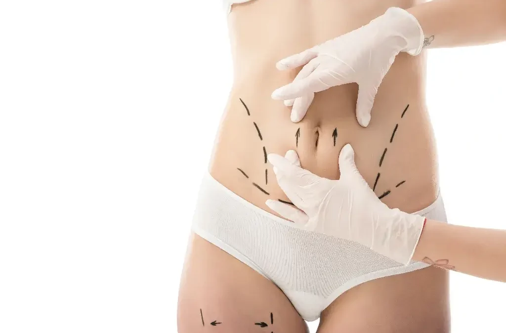 Liposuccion hanches fesses silhouette