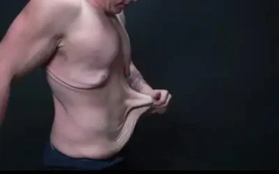 tablier abdominale Tablier abdominal : des solutions chirurgicales à ne pas confondre