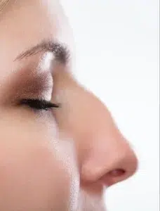 Rhinoplastie médicale