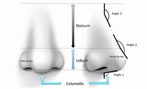 Rhinoplastie medicale