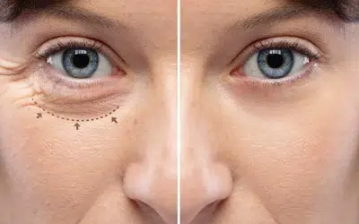 blepharoplastie Vieillissement pourtour yeux causes conséquences