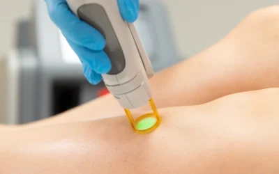 epilation laser épilation laser réponses à vos questions