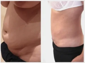 Quel type d'abdominoplastie choisir