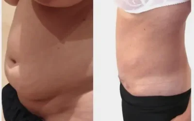 Quel type d abdominoplastie choisir Quel type d’abdominoplastie choisir