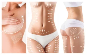 Envisagez mommy makeover, L'abdominoplastie après grossesse