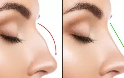rhinoplastie tunisie Objectifs moyens de la rhinoplastie