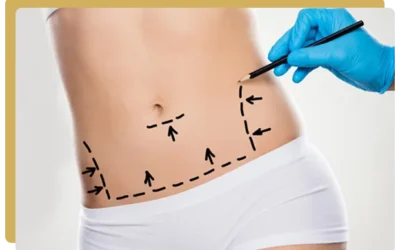 Abdominoplastie choisir le bon moment pour de meilleurs resultats Abdominoplastie choisir le bon moment pour de meilleurs résultats