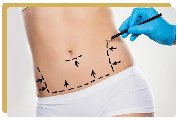 Abdominoplastie choisir le bon moment pour de meilleurs résultats