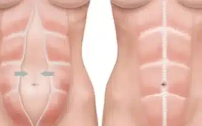 Diastasis Mieux comprendre diastasis traitement