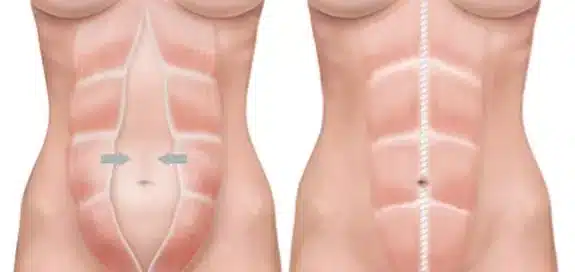 Mieux comprendre diastasis traitement