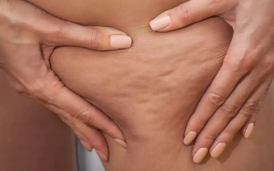 Traitements véritablement efficaces contre cellulite