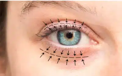 blepharoplastie differencier le vrai du faux blépharoplastie différencier le vrai du faux