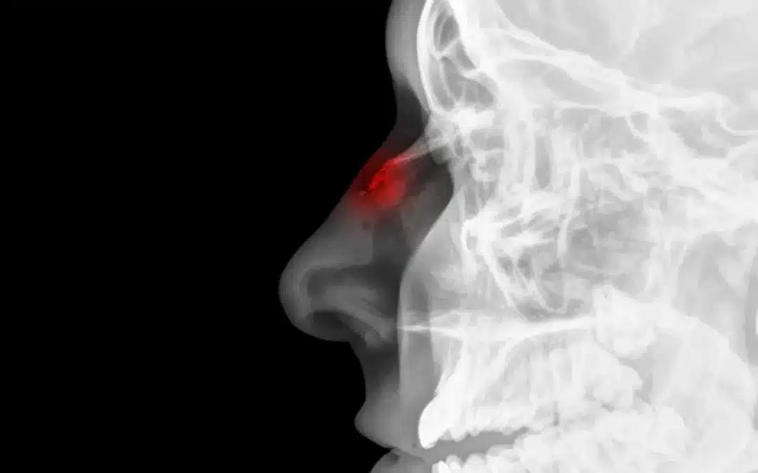 Rhinoplastie pour réparer les blessures sportives, La rhinoplastie est-elle nécessaire après une fracture du nez