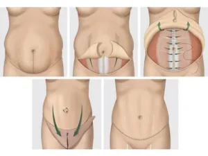 tablier abdominal causes et traitement