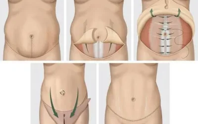abdominoplastie Tablier abdominal causes et traitement