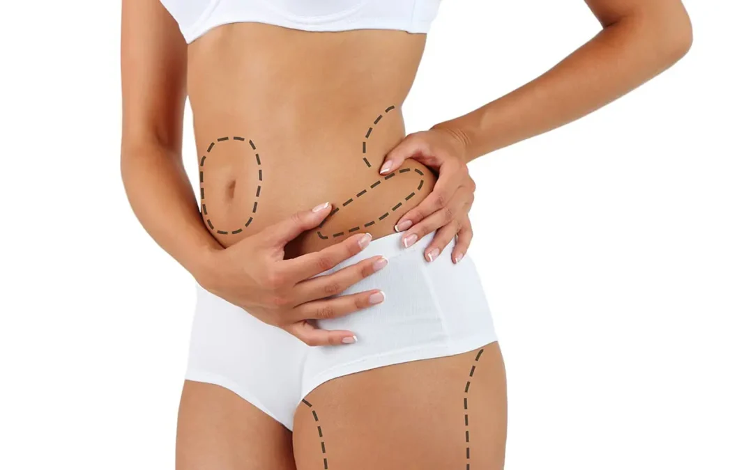 preparez votre ventre plage grace abdominoplastie