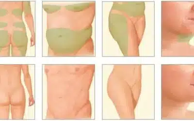 liposuccion questions reponses liposuccion questions reponses