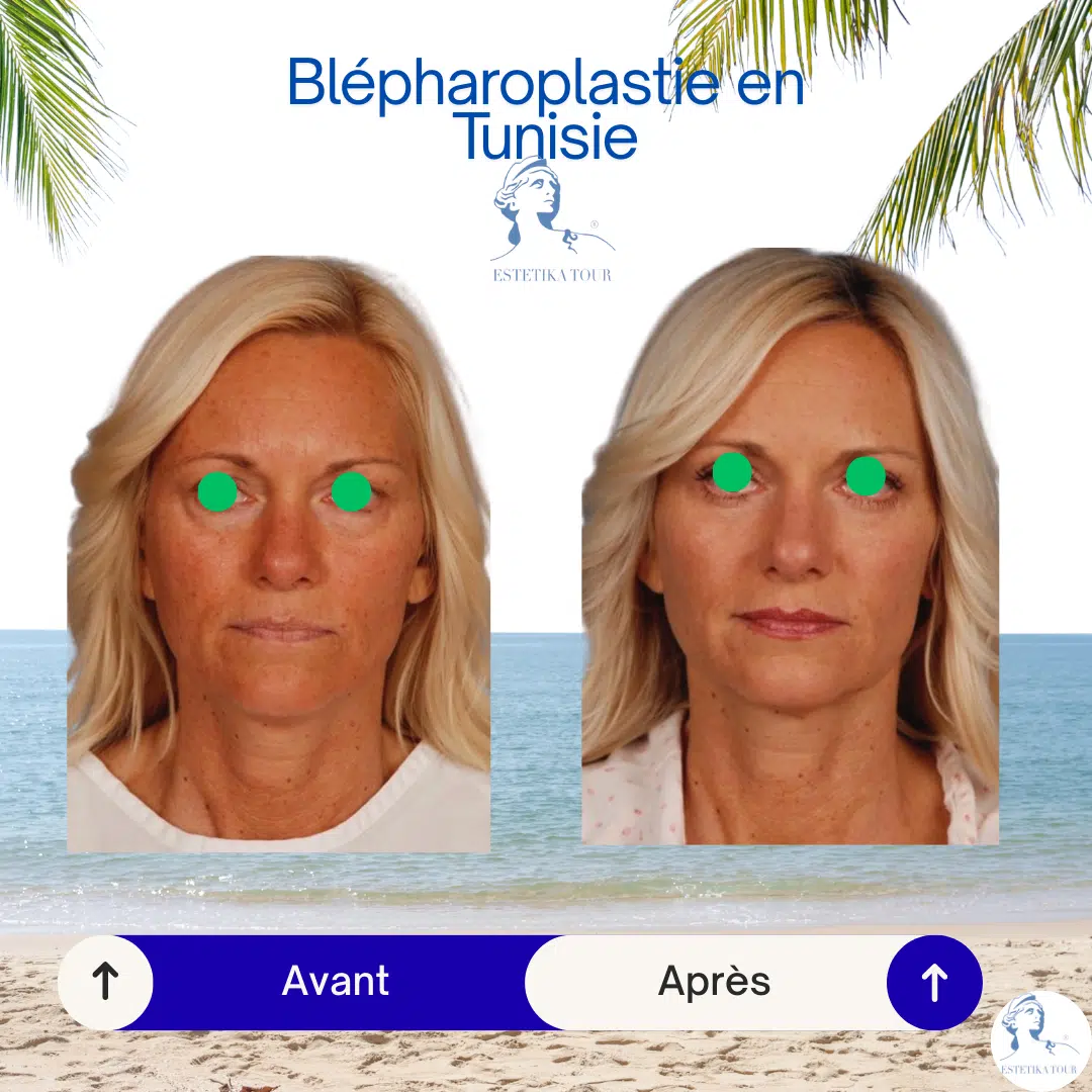 Blépharoplastie en Tunisie