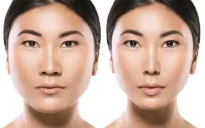 rhinoplastie les differences asie occident estetika rhinoplastie les differences asie occident