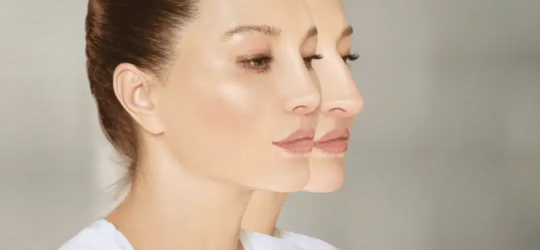 Chirurgie du nez la rhinoplastie