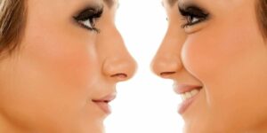 Rhinoplasty in Tunisia