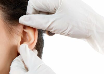 CHIRURGIE DES OREILLES DÉCOLLÉES: OTOPLASTIE, corriger difformités oreilles