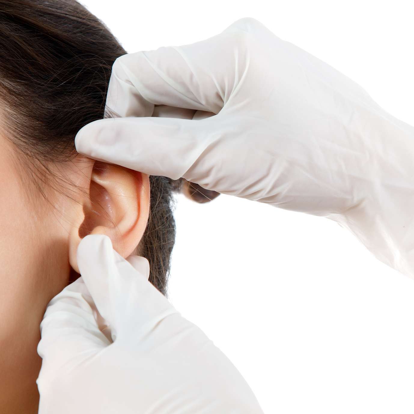 CHIRURGIE DES OREILLES DÉCOLLÉES: OTOPLASTIE