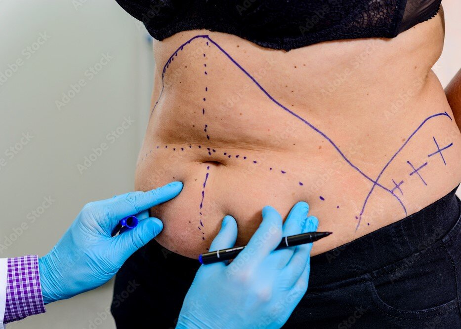 Abdominoplastie : choisir le bon moment pour de meilleurs résultats