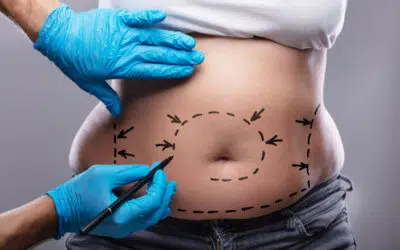 abdominoplastie tunisie abdominoplastie Tunisie chirurgie esthétique