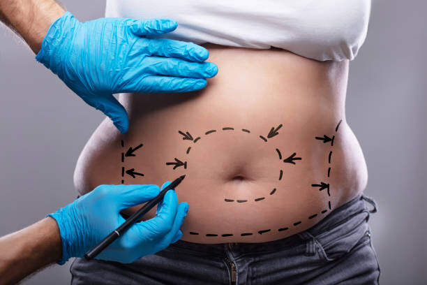 abdominoplastie Tunisie chirurgie esthétique