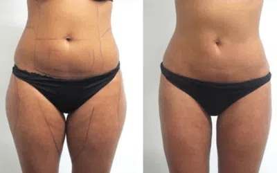 Liposuccion estetika e1677874394667 Liposuccion ventre prix France