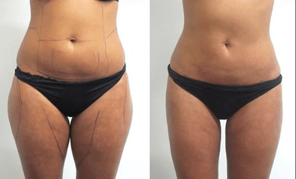 Liposuccion estetika Liposculpture Tunisie Prix
