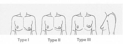 Chirurgie des Seins Tubéreux