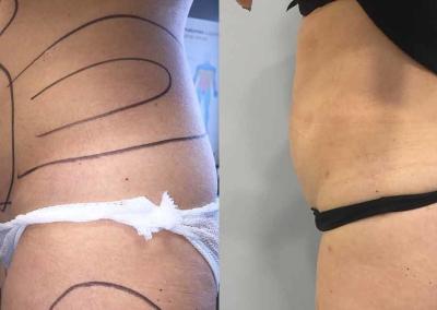 chirurgie esthetique tunisie avant apres